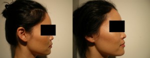 Dermal Fillers for Nose