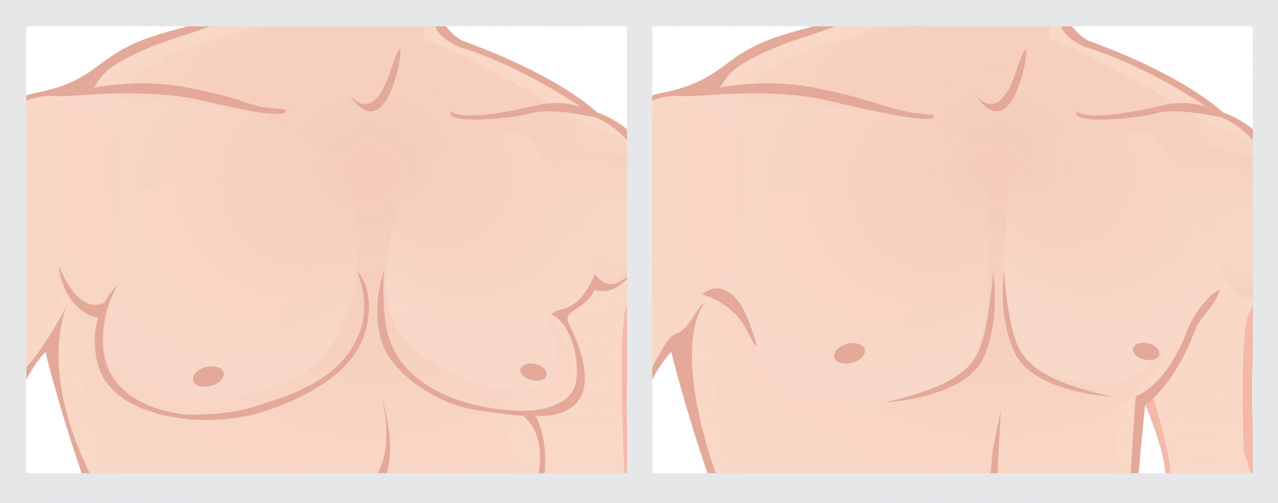 BREAST REDUCTION CHANDLER