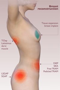 What is Tissue Expansion: Growing Extra Skin for Reconstruction