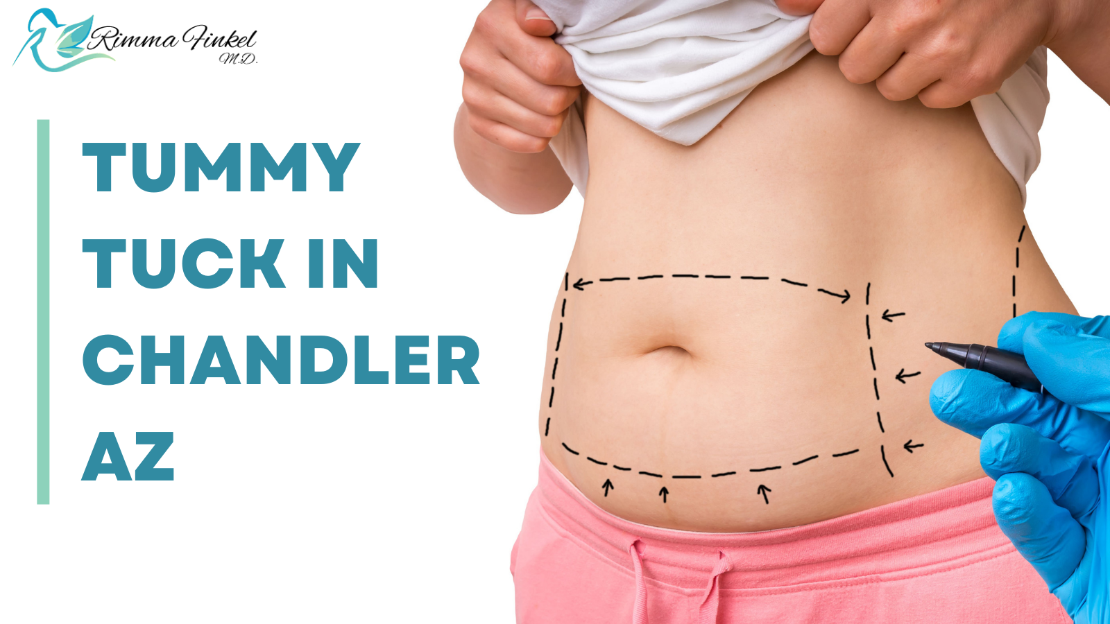 Tummy Tuck in Chandler AZ