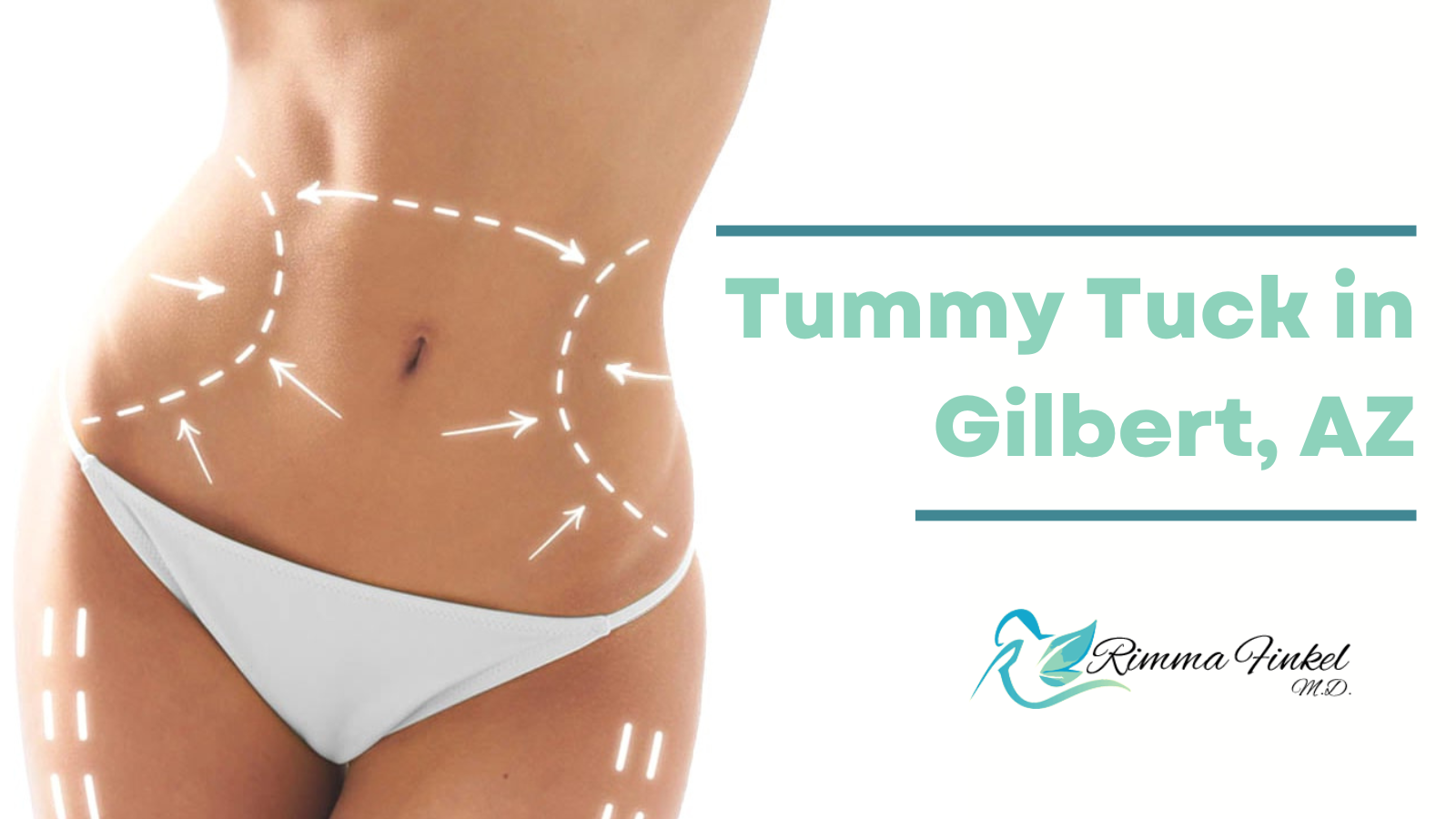 Tummy Tuck in Gilbert AZ